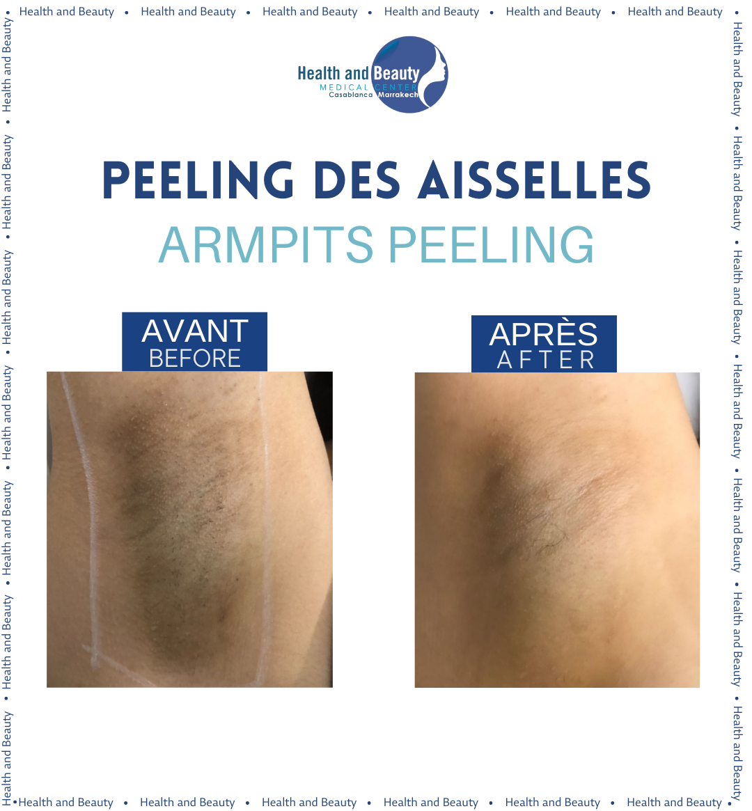 resultat peeling hyperpigmentation aisselles